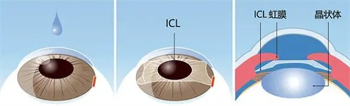 icl晶体植入展示图