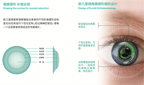 欧几里德角膜塑形镜设计原理