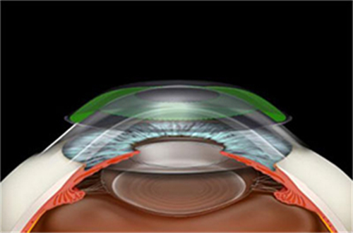 美国CRT角膜塑形镜原理展示