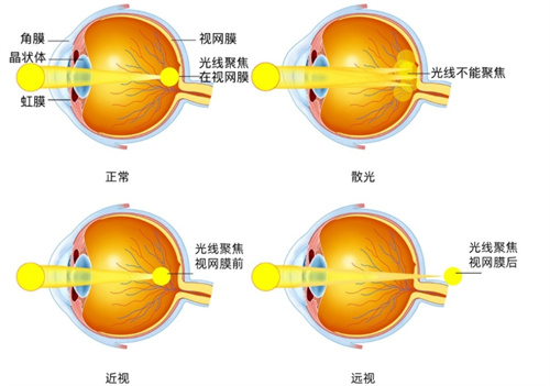 近视和远视对比图