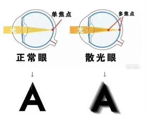 正常眼和散光眼的对比