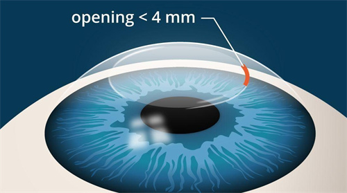 全飞秒角膜切口图