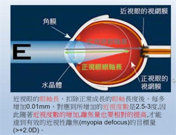 近视眼轴长度的变化图解