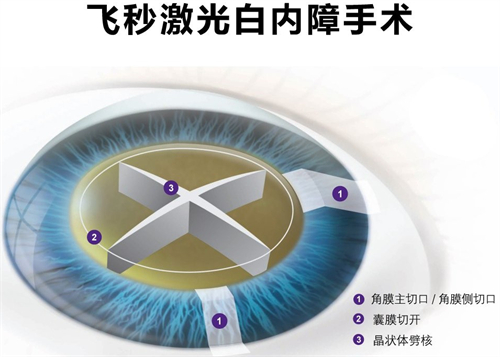 飞秒白内障手术细节图