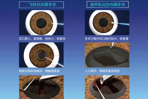 飞秒白内障和超声乳化白内障