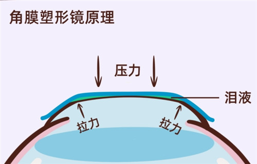 角膜塑形镜原理