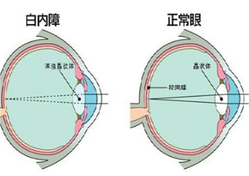 白内障和正常眼睛的区别图解