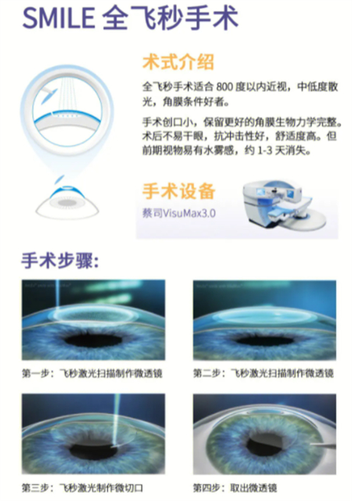 全飞秒近视手术术式介绍图解