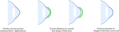 角膜塑形镜改善眼角弧度流程图