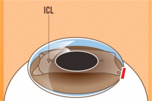 ICL晶体植入后示意图