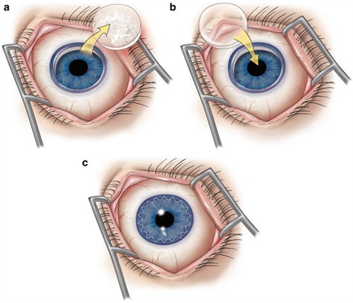 角膜移植过程展示