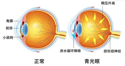 急性闭角型青光眼