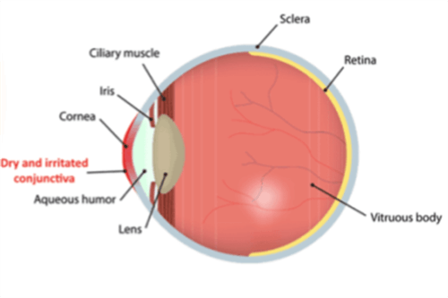 干眼症眼结构图
