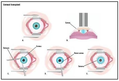 角膜移植手术过程图展示
