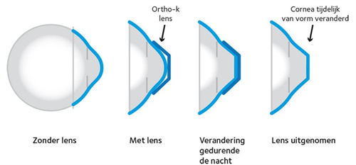 角膜塑形镜的改善过程