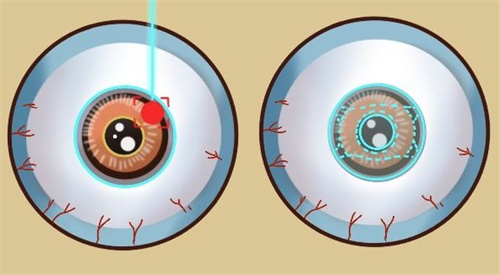 激光类近视手术和ICL晶体植入手术
