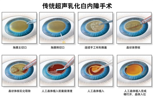 白内障超声乳化手术流程图