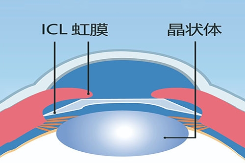 ICL晶体植入卡通图