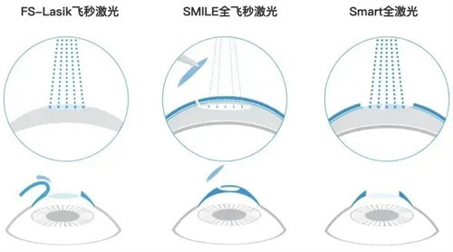 在线解答:近视眼手术利与弊、风险和后遗症有哪些?老了会有什么影响吗?