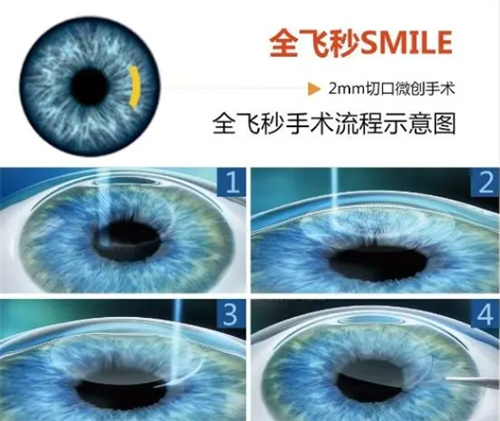 新技术解析:深入揭秘个性化近视眼手术有哪些项目?3D模型+AI算法助你恢复理想视力!