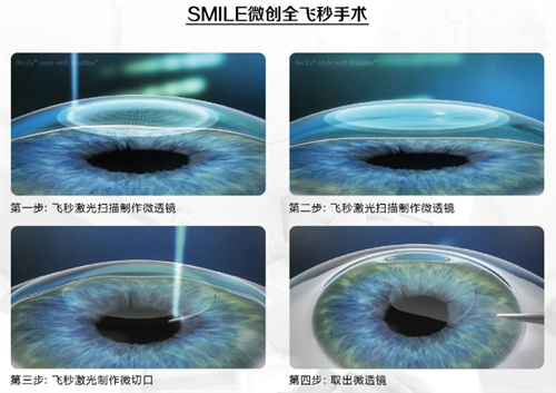 尖峰眼科近视手术怎么样?技术成熟吗?是正规的眼科机构提供技术成熟且到位的手术