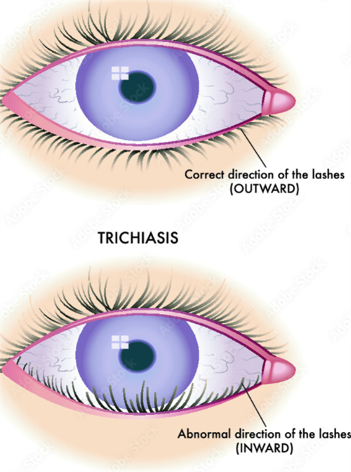 正常睫毛和倒睫的区别