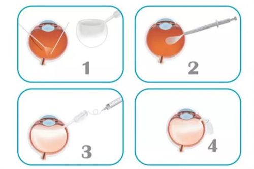人工玻璃体植入手术过程