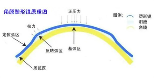 角膜塑形镜原理示意图