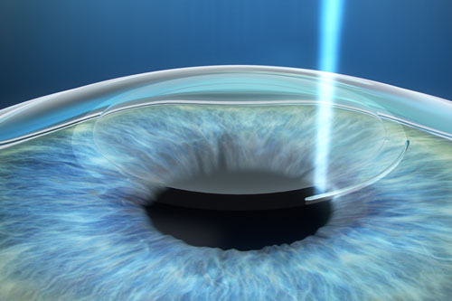 ​佰视佳眼科医院做近视眼手术怎么样，专做近视手术医生技术十分成熟！