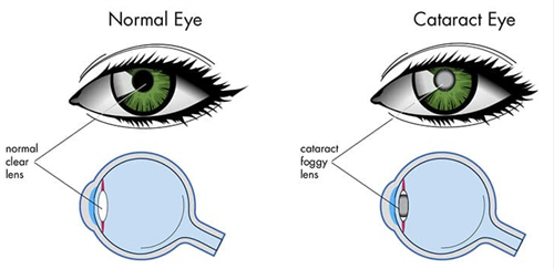 正常眼睛和白内障眼睛晶体区别