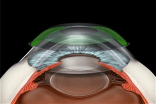 角膜塑形镜原理示意图
