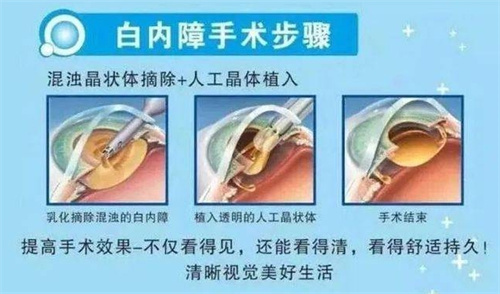 白内障免费晶体好吗？免费的白内障手术使用的晶体可靠吗？