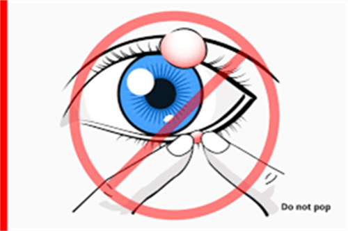 麦粒肿不可以手挤