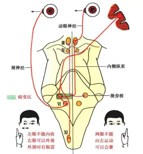 眼肌麻痹重影能治好吗?在线为你解答六种不同症状眼肌麻痹的治疗方法~