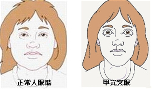 甲亢突眼对比图