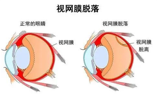 视网膜脱落示意图