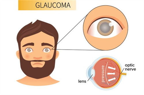 青光眼结构照片