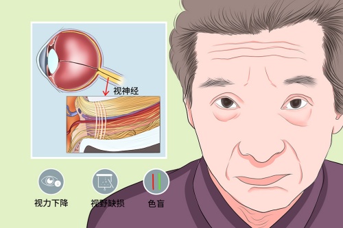 视神经萎缩症状卡通图