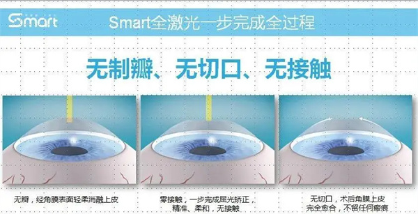 smart全激光手术过程