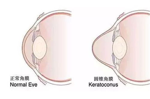 正常角膜和圆锥角膜的区别