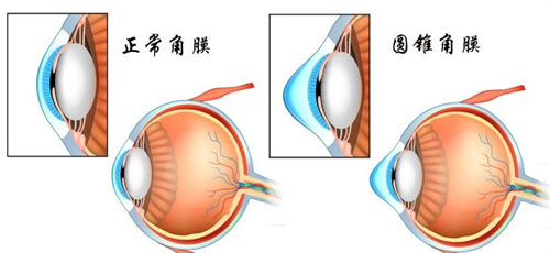 正常角膜和圆锥角膜