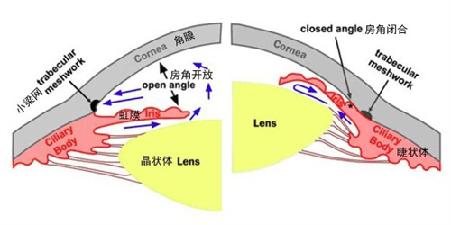 青光眼和正常眼睛的对比