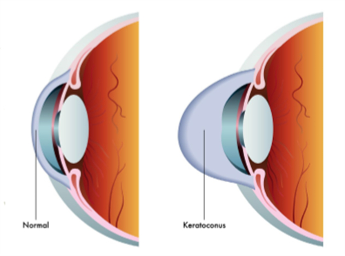 圆锥角膜交联术成熟吗?术后对视力能有提升吗?是不是必须要带RGP?