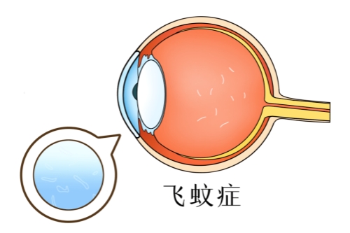 飞蚊症动漫素材