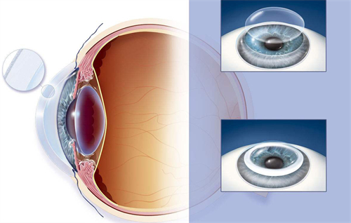 ​角膜移植医保可以报销吗，在一定条件下是可以纳入报销范围的！