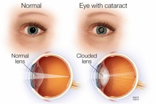 正常眼结构与白内障眼结构对比