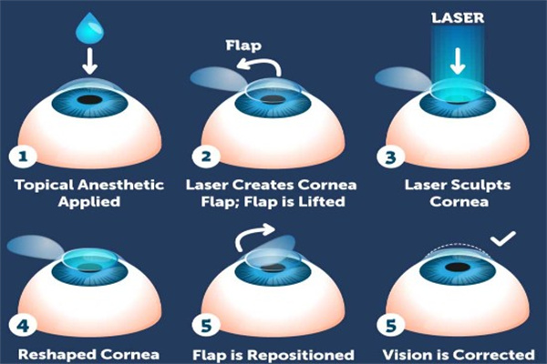 激光治疗近视眼动画图