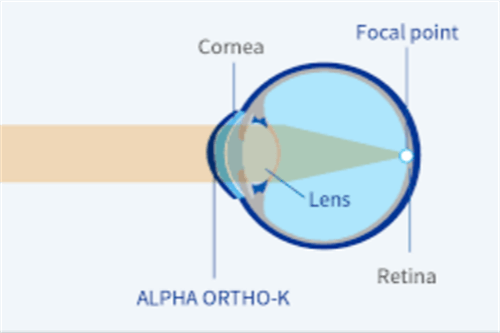 角膜塑形镜图示