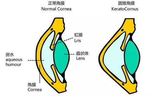 正常角膜和圆锥角膜的区别