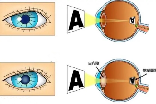 白内障和正常眼睛卡通对比图